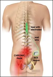 Chronic Pain Therpaies