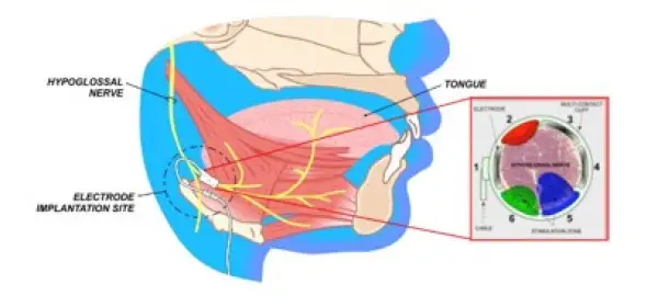 Click Here To Enlarge This Photo Of A New Way to Breathe&nbsp;